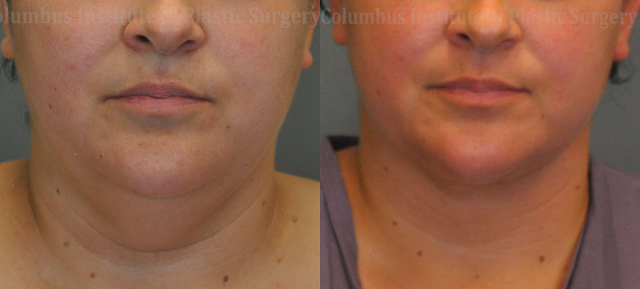 Liposuction before and after photo by Columbus Institute of Plastic Surgery in Columbus, OH