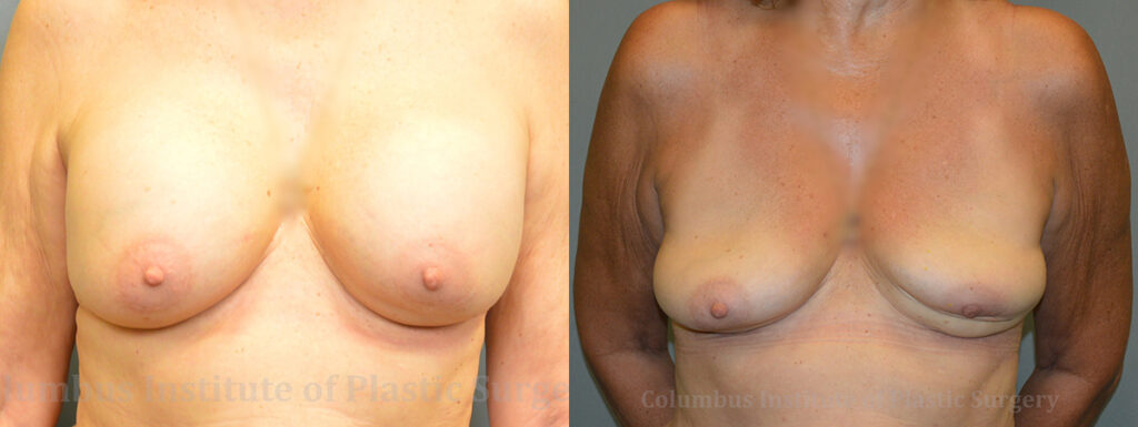 Breast Implant Removal before and after photo by Columbus Institute of Plastic Surgery in Columbus, OH