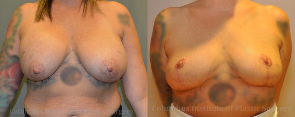 Breast Implant Removal before and after photo by Columbus Institute of Plastic Surgery in Columbus, OH