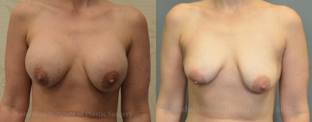 Breast Implant Removal before and after photo by Columbus Institute of Plastic Surgery in Columbus, OH