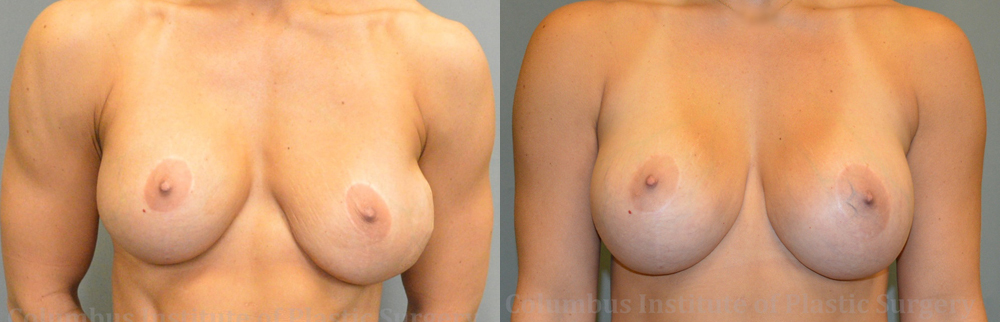 Breast Augmentation Revision before and after photo by Columbus Institute of Plastic Surgery in Columbus, OH