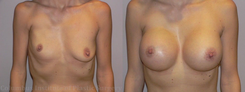 Breast Augmentation – 500cc-600cc before and after photo by Columbus Institute of Plastic Surgery in Columbus, OH