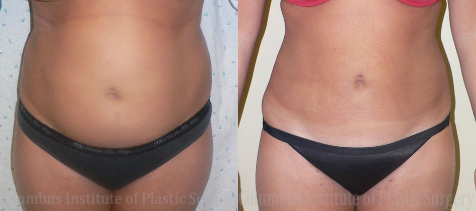 Liposuction before and after photo by Columbus Institute of Plastic Surgery in Columbus, OH