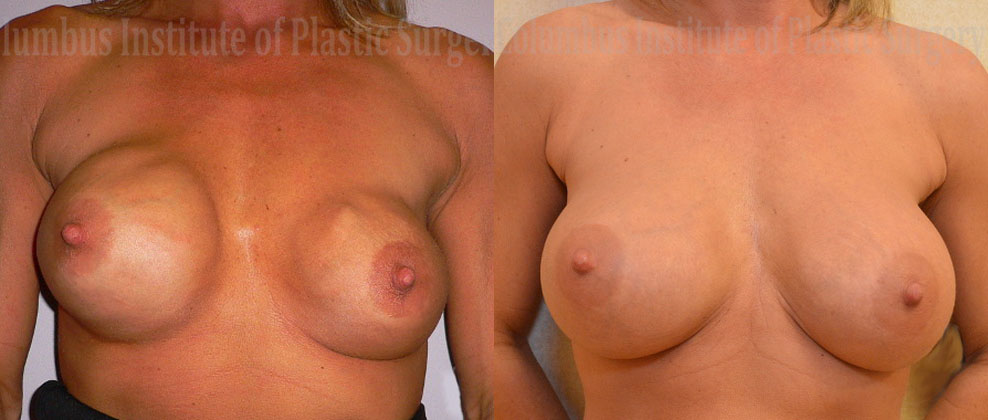 Breast Augmentation Revision before and after photo by Columbus Institute of Plastic Surgery in Columbus, OH