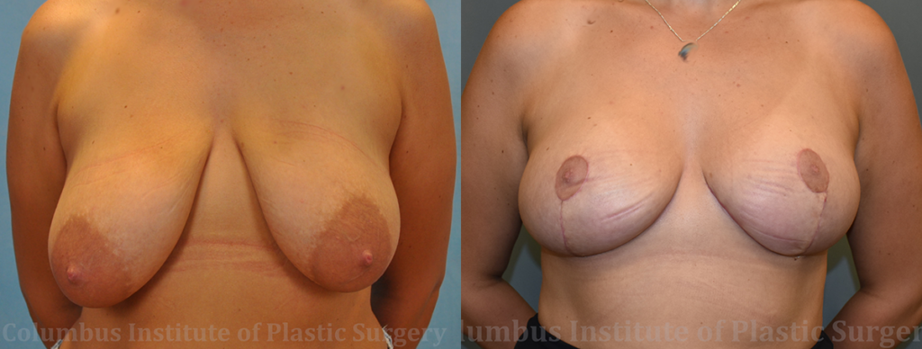 Breast Lift (Mastopexy) before and after photo by Columbus Institute of Plastic Surgery in Columbus, OH