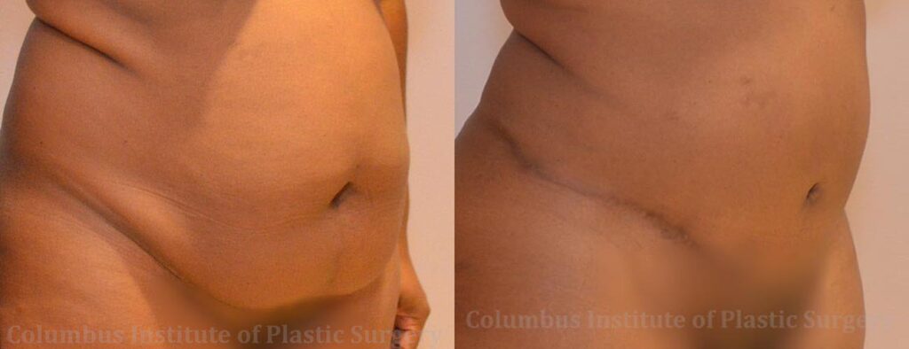 Abdominoplasty (Tummy Tuck) before and after photo by Columbus Institute of Plastic Surgery in Columbus, OH