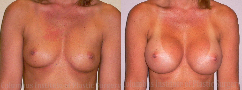 Breast Augmentation – 400cc-500cc before and after photo by Columbus Institute of Plastic Surgery in Columbus, OH