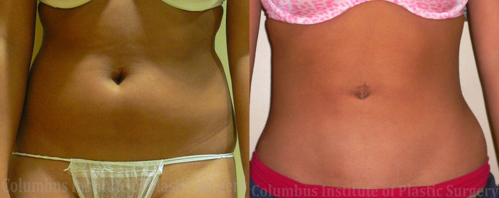 Liposuction before and after photo by Columbus Institute of Plastic Surgery in Columbus, OH