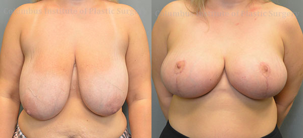 Breast Lift (Mastopexy) before and after photo by Columbus Institute of Plastic Surgery in Columbus, OH