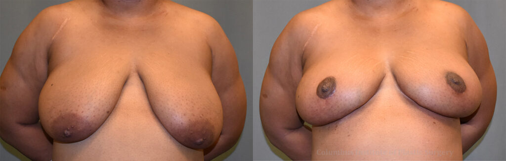 Breast Lift (Mastopexy) before and after photo by Columbus Institute of Plastic Surgery in Columbus, OH