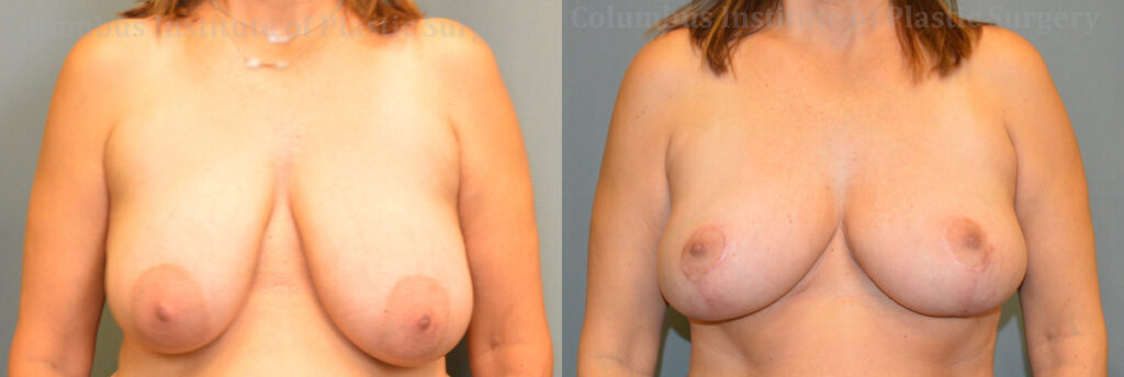 Breast Lift (Mastopexy) before and after photo by Columbus Institute of Plastic Surgery in Columbus, OH