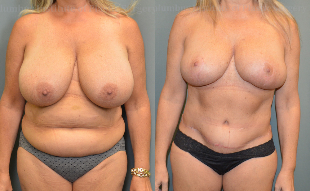 Breast Lift (Mastopexy) before and after photo by Columbus Institute of Plastic Surgery in Columbus, OH