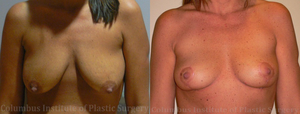 Breast Lift (Mastopexy) before and after photo by Columbus Institute of Plastic Surgery in Columbus, OH