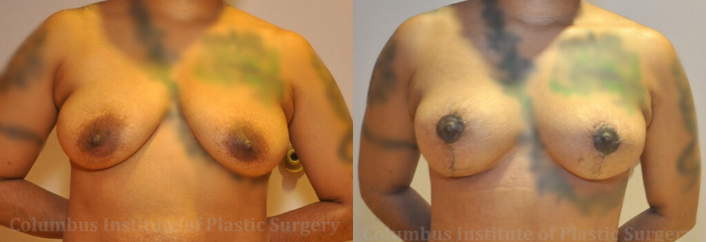 Breast Lift (Mastopexy) before and after photo by Columbus Institute of Plastic Surgery in Columbus, OH