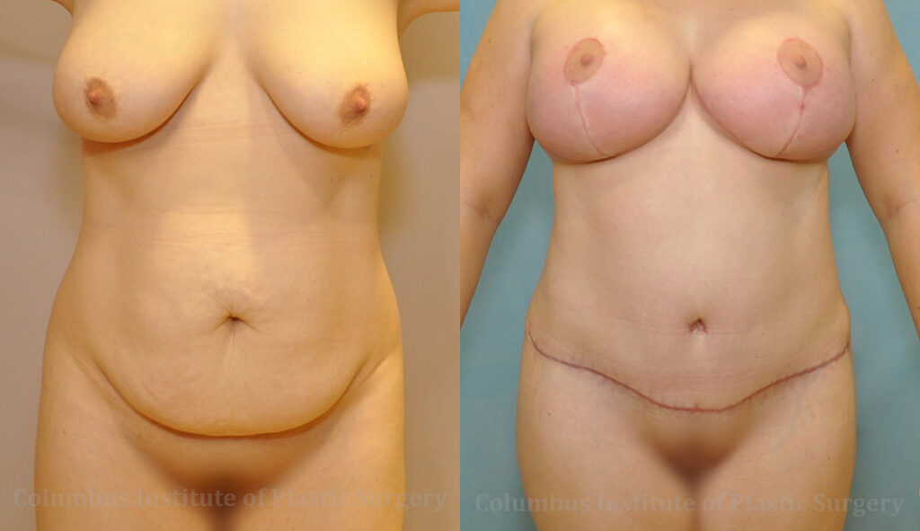 Breast Lift (Mastopexy) before and after photo by Columbus Institute of Plastic Surgery in Columbus, OH