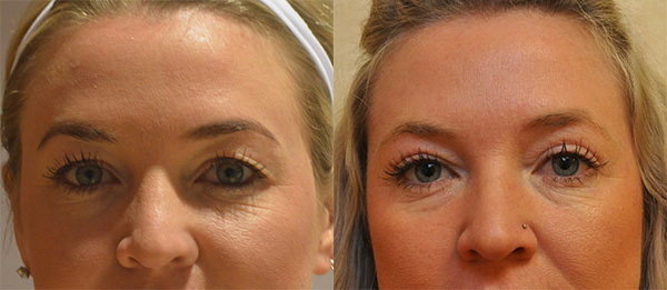 Blepharoplasty before and after photo by Columbus Institute of Plastic Surgery in Columbus, OH
