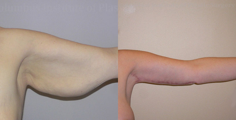 Brachioplasty (Arm Lift) before and after photo by Columbus Institute of Plastic Surgery in Columbus, OH