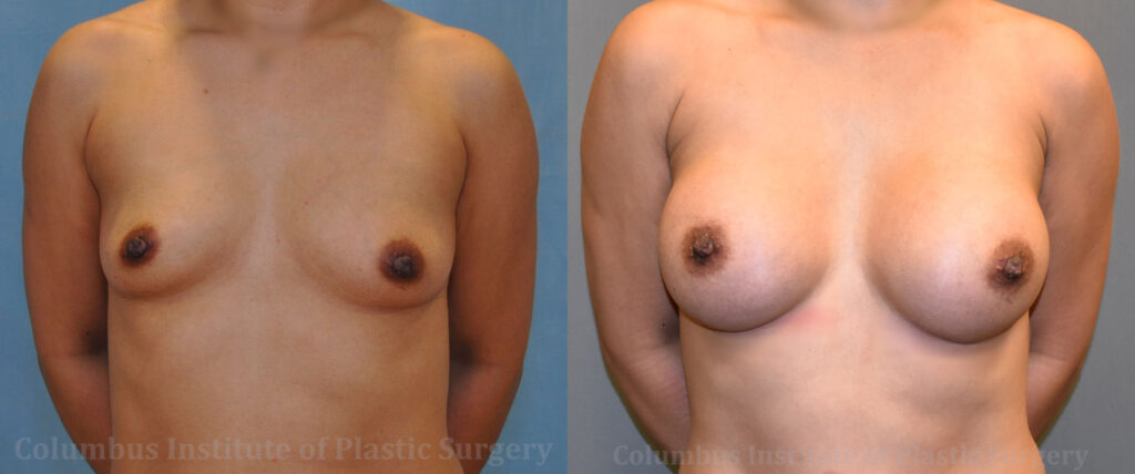 Breast Augmentation – 400cc-500cc before and after photo by Columbus Institute of Plastic Surgery in Columbus, OH