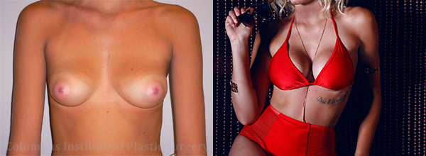 Breast Implant Patient Photoshoot before and after photo by Columbus Institute of Plastic Surgery in Columbus, OH