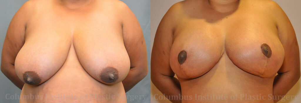 Breast Reduction before and after photo by Columbus Institute of Plastic Surgery in Columbus, OH