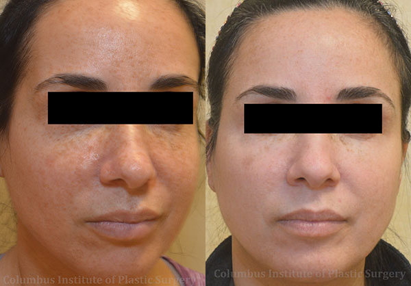 TCA Chemical Peel before and after photo by Columbus Institute of Plastic Surgery in Columbus, OH