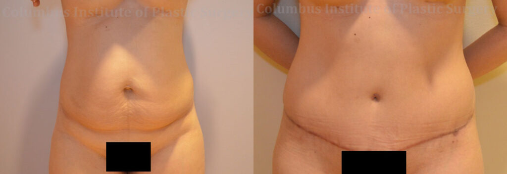 Abdominoplasty (Tummy Tuck) before and after photo by Columbus Institute of Plastic Surgery in Columbus, OH