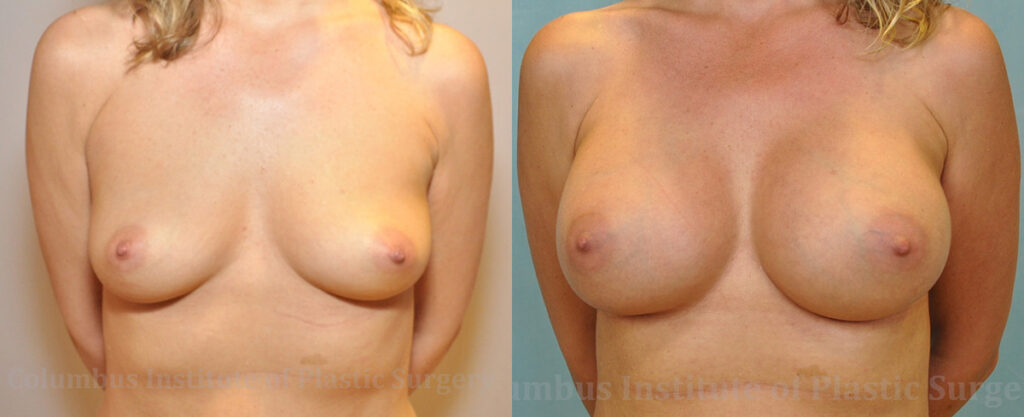 Breast Augmentation before and after photo by Columbus Institute of Plastic Surgery in Columbus, OH