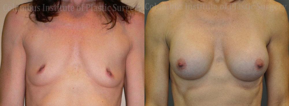 Breast Augmentation – 300cc-400cc before and after photo by Columbus Institute of Plastic Surgery in Columbus, OH