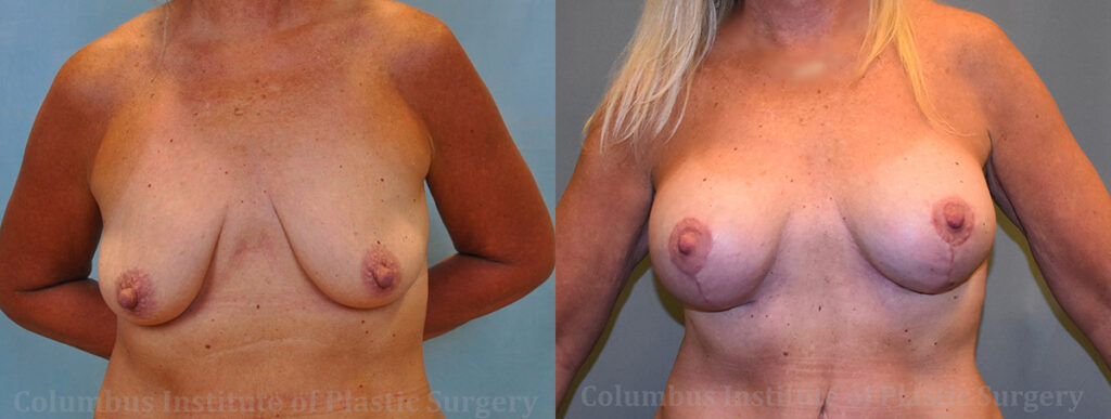Breast Lift and Augmentation (Implants) before and after photo by Columbus Institute of Plastic Surgery in Columbus, OH