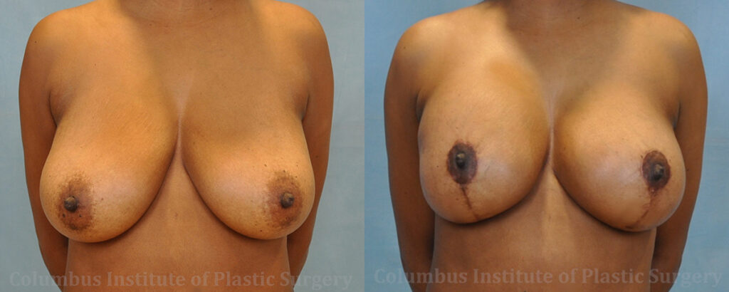 Breast Lift and Augmentation (Implants) before and after photo by Columbus Institute of Plastic Surgery in Columbus, OH