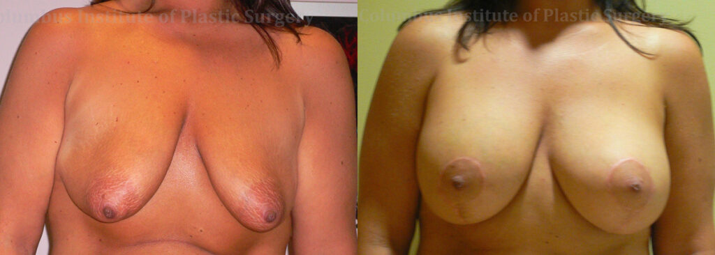 Breast Lift and Augmentation (Implants) before and after photo by Columbus Institute of Plastic Surgery in Columbus, OH