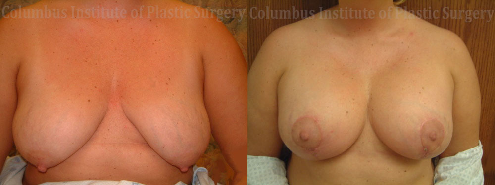 Breast Lift and Augmentation (Implants) before and after photo by Columbus Institute of Plastic Surgery in Columbus, OH