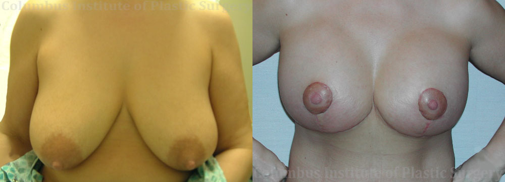 Breast Lift and Augmentation (Implants) before and after photo by Columbus Institute of Plastic Surgery in Columbus, OH