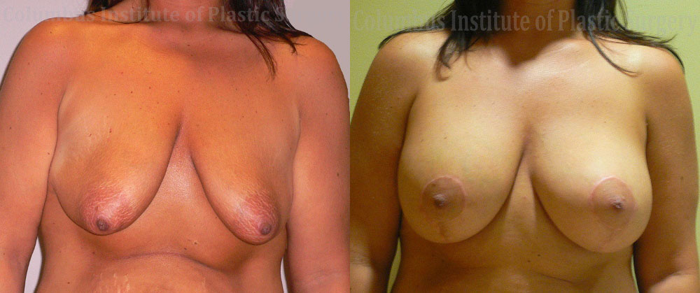 Breast Lift and Augmentation (Implants) before and after photo by Columbus Institute of Plastic Surgery in Columbus, OH