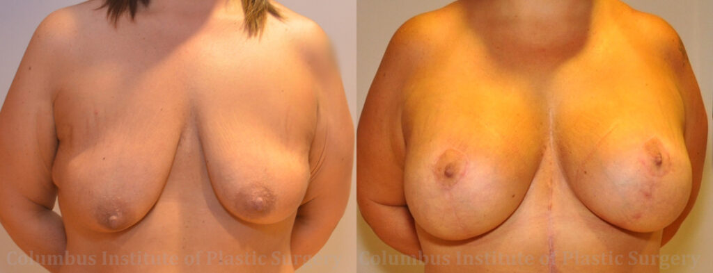 Breast Lift and Augmentation (Implants) before and after photo by Columbus Institute of Plastic Surgery in Columbus, OH