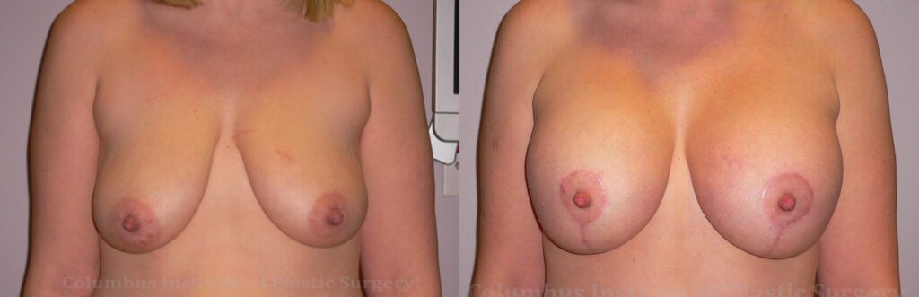 Breast Lift and Augmentation (Implants) before and after photo by Columbus Institute of Plastic Surgery in Columbus, OH