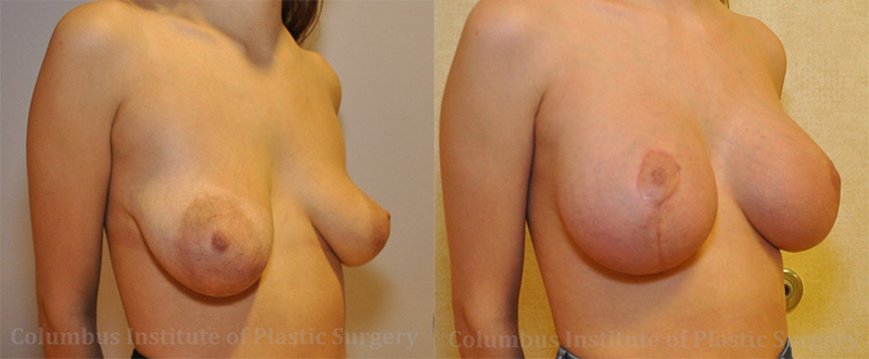 Breast Lift and Augmentation (Implants) before and after photo by Columbus Institute of Plastic Surgery in Columbus, OH
