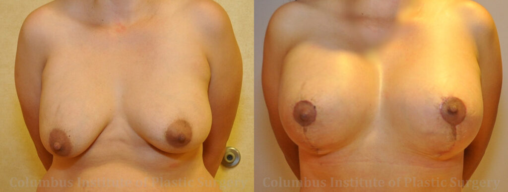 Breast Lift and Augmentation (Implants) before and after photo by Columbus Institute of Plastic Surgery in Columbus, OH