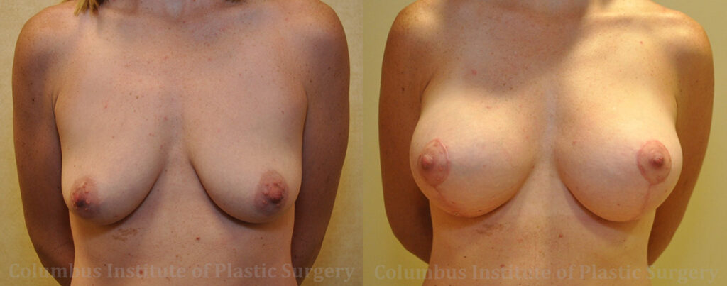 Breast Lift and Augmentation (Implants) before and after photo by Columbus Institute of Plastic Surgery in Columbus, OH