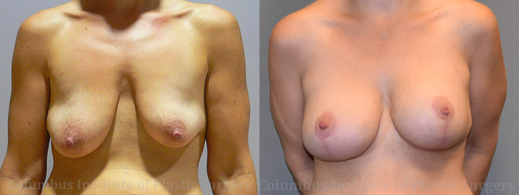 Breast Lift and Augmentation (Implants) before and after photo by Columbus Institute of Plastic Surgery in Columbus, OH