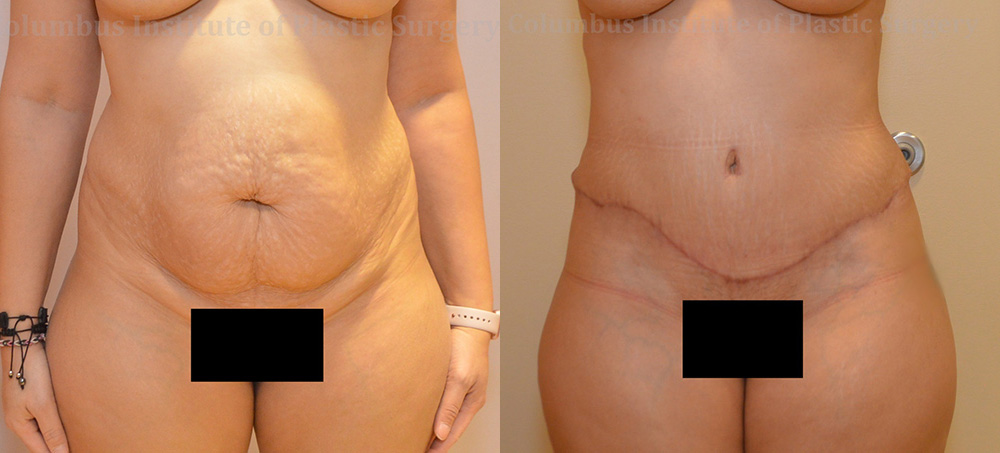 Abdominoplasty (Tummy Tuck) before and after photo by Columbus Institute of Plastic Surgery in Columbus, OH