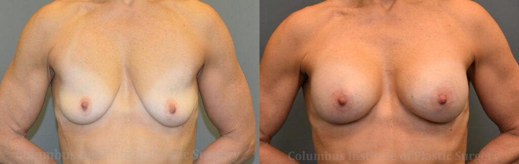 Breast Augmentation – 300cc-400cc before and after photo by Columbus Institute of Plastic Surgery in Columbus, OH