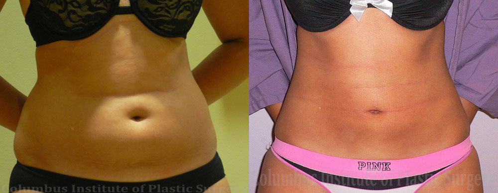 Liposuction before and after photo by Columbus Institute of Plastic Surgery in Columbus, OH