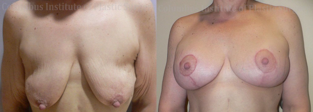 Breast Lift with Augmentation after Weight Loss before and after photo by Columbus Institute of Plastic Surgery in Columbus, OH