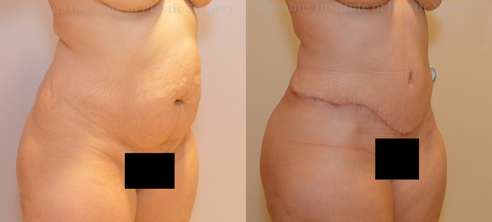 Abdominoplasty (Tummy Tuck) before and after photo by Columbus Institute of Plastic Surgery in Columbus, OH Abdominoplasty (Tummy Tuck) before and after photo by Columbus Institute of Plastic Surgery in Columbus, OH