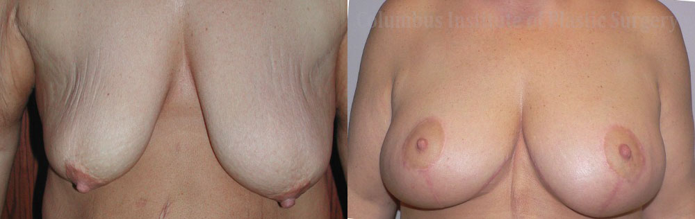 Breast Lift with Augmentation after Weight Loss before and after photo by Columbus Institute of Plastic Surgery in Columbus, OH