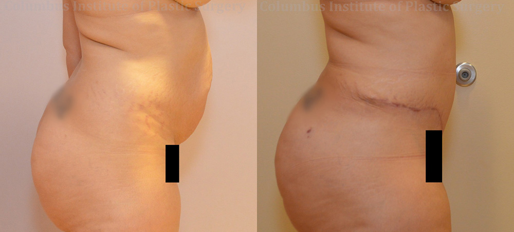 Abdominoplasty (Tummy Tuck) before and after photo by Columbus Institute of Plastic Surgery in Columbus, OH Abdominoplasty (Tummy Tuck) before and after photo by Columbus Institute of Plastic Surgery in Columbus, OH