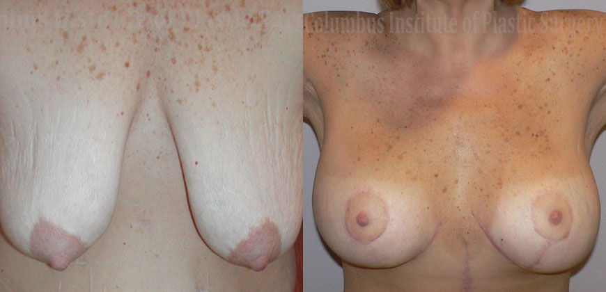 Breast Lift with Augmentation after Weight Loss before and after photo by Columbus Institute of Plastic Surgery in Columbus, OH