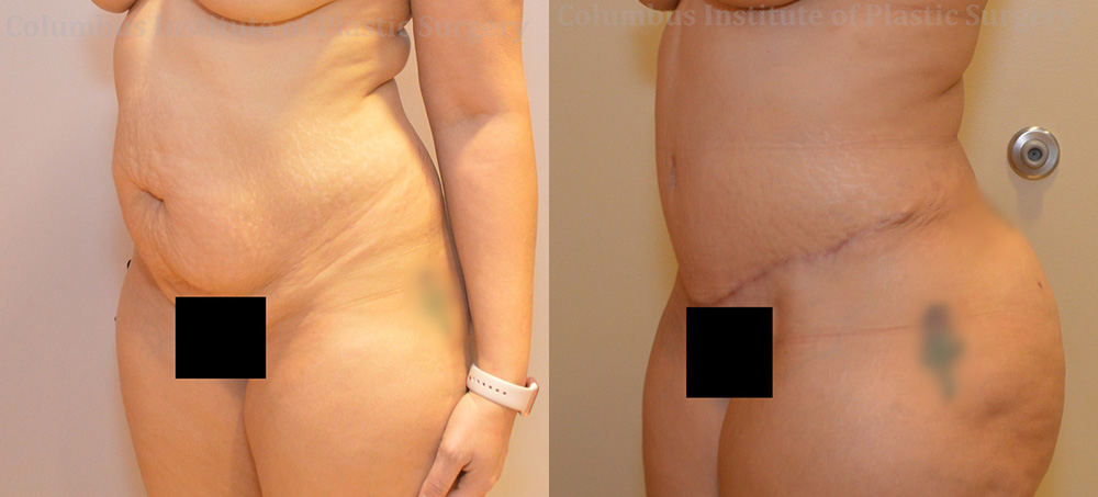 Abdominoplasty (Tummy Tuck) before and after photo by Columbus Institute of Plastic Surgery in Columbus, OH Abdominoplasty (Tummy Tuck) before and after photo by Columbus Institute of Plastic Surgery in Columbus, OH