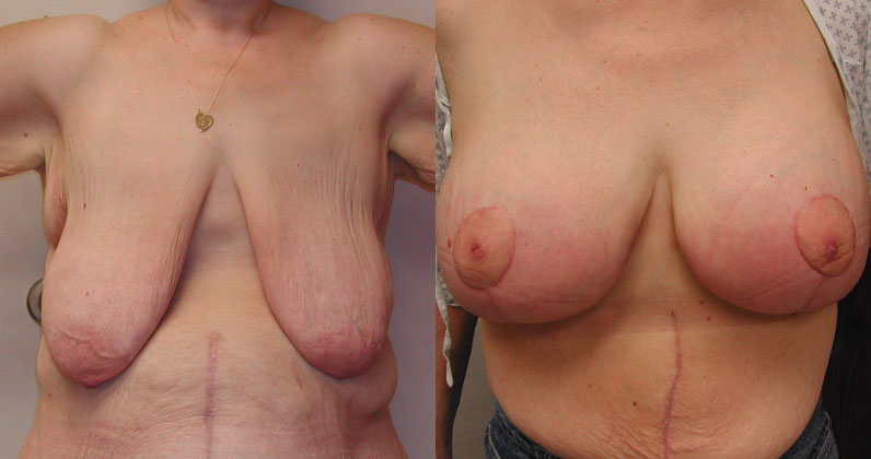 Breast Lift with Augmentation after Weight Loss before and after photo by Columbus Institute of Plastic Surgery in Columbus, OH